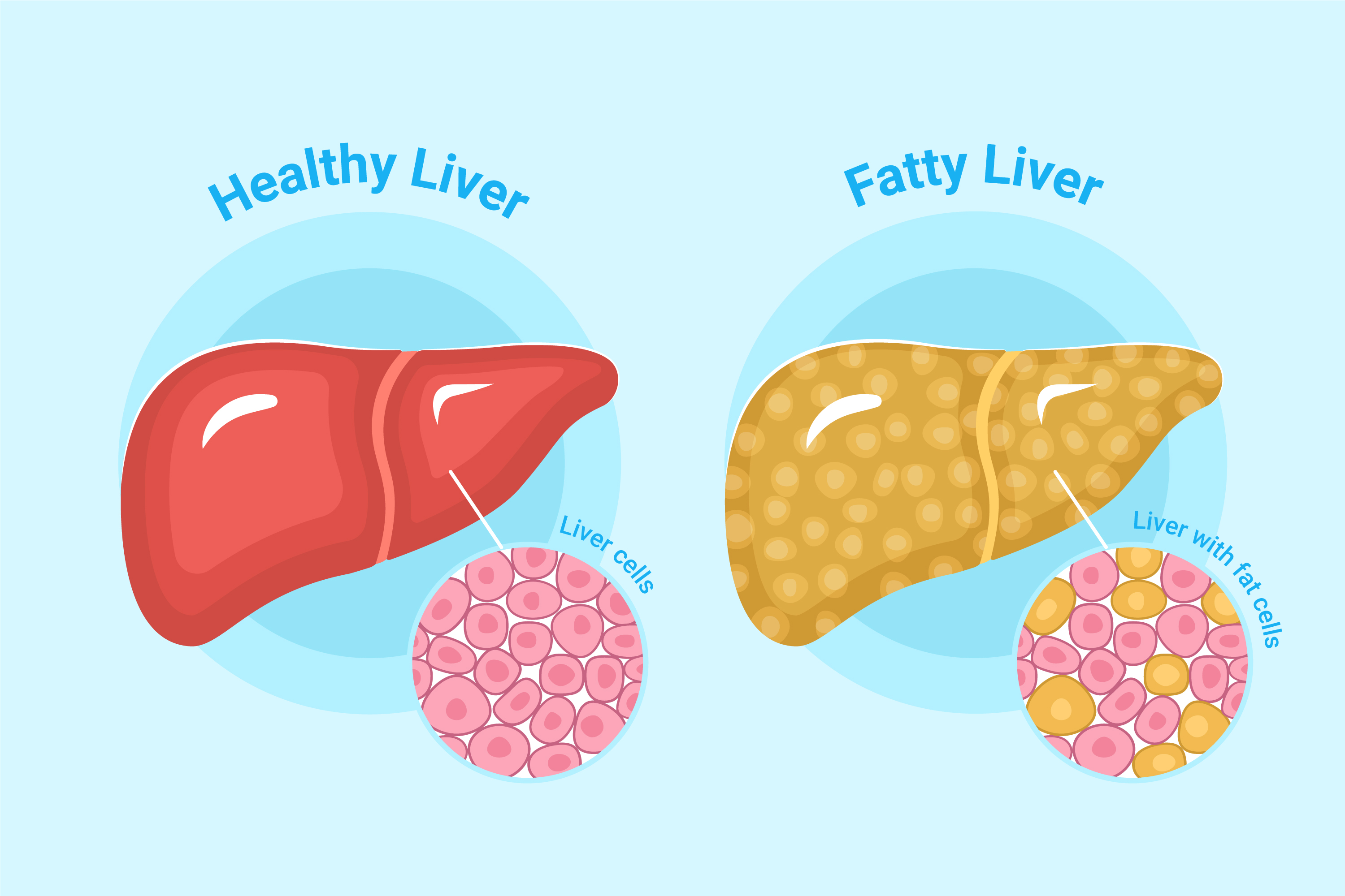 How Ayurvedic Medicine For Fatty Liver Supports Liver Health